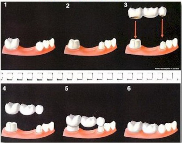 Vật liệu sử dụng để làm mão răng và cầu răng