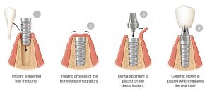 Cấy Ghép Implant Giá Rẻ Cần Thơ – Bảo Hành Trọn Đời