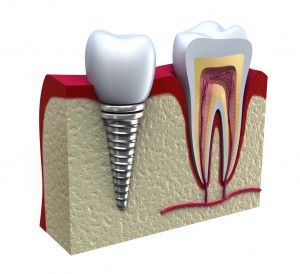 Lợi Ích Của Trồng Răng Implant – Nha Khoa Sài Gòn – Bs. Lâm