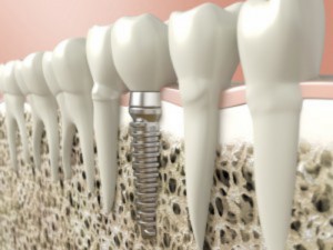 http://nhakhoasaigonbacsilam.com/dia-chi-trong-implant-uy-tin-can-tho/