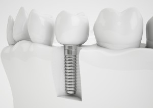 Những Lợi Ích Trồng Răng Implant – Nha Khoa Uy Tín Cần Thơ