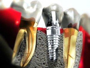 Lợi Ích Của Trồng Răng Implant – Nha Khoa Sài Gòn – Bs. Lâm