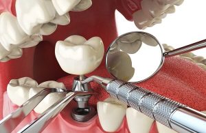 Cấy ghép Implant – Nha Khoa Trồng Răng Ở Cần Thơ
