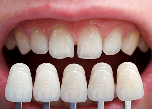 Dán sứ veneer giá bao nhiêu 
