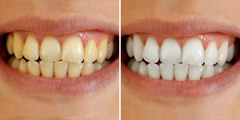 Răng vàng có tẩy trắng được không