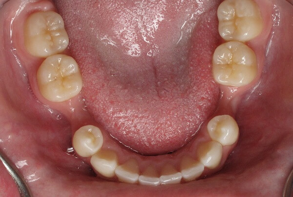 Tiêu xương hàm có cấy implant được không