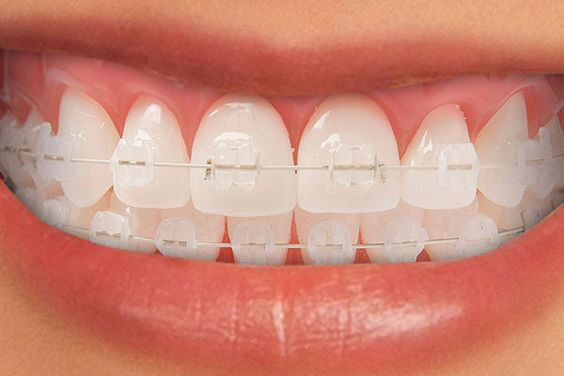 Tìm hiểu về niềng răng thẩm mỹ mắc cài sứ