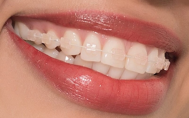 Tìm hiểu về niềng răng thẩm mỹ mắc cài sứ