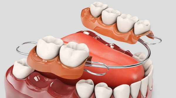 Giải pháp trồng răng tối ưu cho người lớn tuổi 