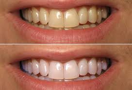 Răng nhiễm màu kháng sinh có tẩy trắng được không?