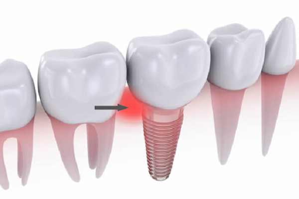 Tìm hiểu về dấu hiệu đào thải trụ Implant