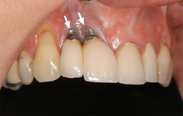Tìm hiểu về dấu hiệu đào thải trụ Implant