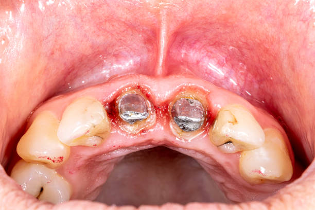 Tìm hiểu về dấu hiệu đào thải trụ Implant